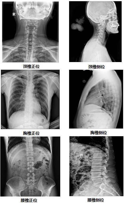 國產(chǎn)無線懸吊dr部分臨床效果圖